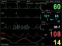 Moniteur patient multiparamétrique GIMA PC-3000 (PNI, SpO2, Temp., Resp, ECG)