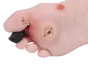 Modèle de pied blessé avec syndrome du pied diabétique Erler Zimmer