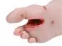 Modèle anatomique de pied diabétique au stade sévère Erler Zimmer