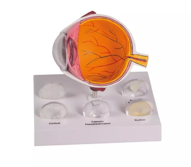 Coupe de l’œil avec cataractes du cristallin F80 Erler Zimmer