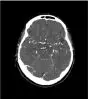 Fantôme tête et cou pour tomodensitométrie radiographie et radiothérapie Erler Zimmer