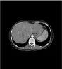 Fantôme abdomen pour tomodensitométrie radiographie et radiothérapie Erler Zimmer