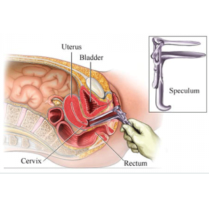 Speculum vaginal